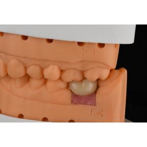 Precision Cylindrical Silver Single Tooth Replacement Implants Dental Restoratio