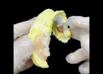 Custom Cast Partial Denture with HPP framework for Enhanced Chewing and Speech