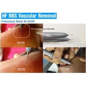 High Frequency Vascular / Spider Vein Removal Machine , Laser Varicose Vein