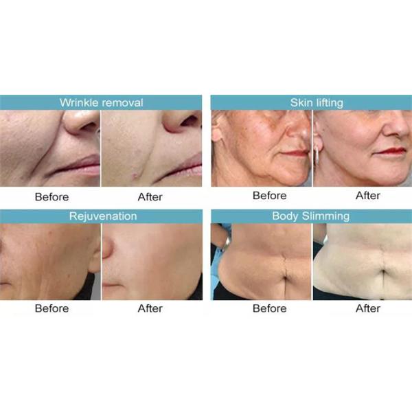 7d Hifu Equipment Portable Ultrasound Face Lifting Anti Wrinkle