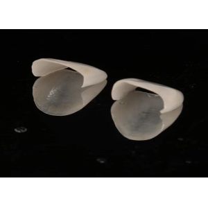 Aesthetic Restoration Emax Ceramic Veneers Translucency with Polished Surface