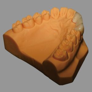 Biocompatible Full Ceramic PFZ Bridge With CAD / CAM System