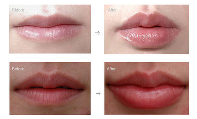 1ml Two BDDE Hyaluronic Acid Dermal Lip Enhancement Fillers Eco Friendly