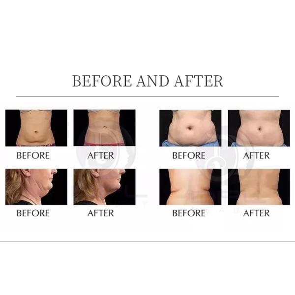 Lipo 8 In 1 80k Ultrasonic Vacuum Cavitation Machine Body Slimming Professional