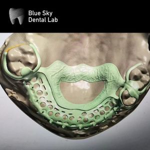 Removable Denture Rpd Framework Design Metal Partial Denture Framework Design