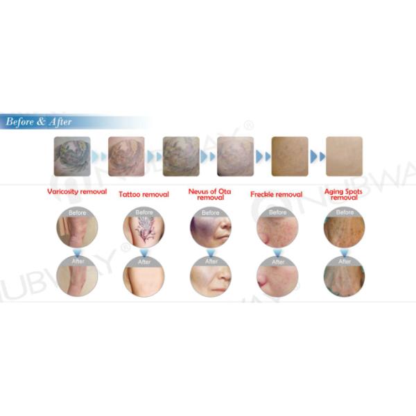 1064nm 532nm Q switch nd yag laser pulsed dye laser for tattoo removal vascular and skin rejuvenation