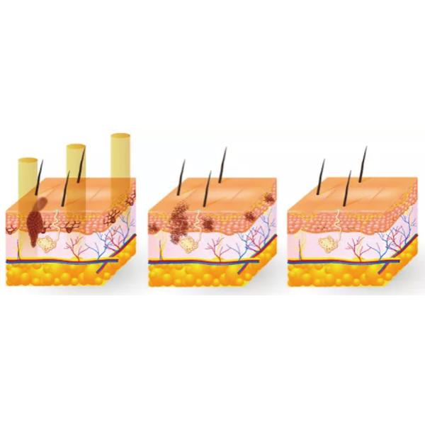 Tattoo Removal 532 1064nm ND YAG Laser Machine