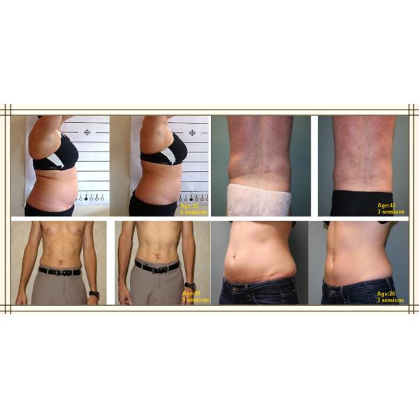 Nubway Lipo Laser Slimming Machine