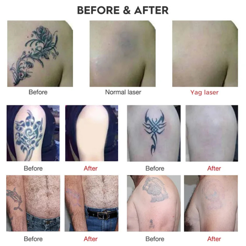 755 1064 532nm ND YAG Laser Tattoo Pigment Removal Device with Professional