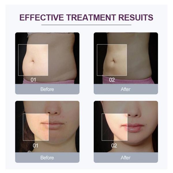 Face Lift 40k Ultrasonic Cavitation 6d Rf Vacuum Slimming Machine Supplier