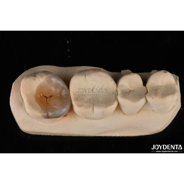 Custom Natural Looking Emax Dental Inlays And Onlays For Tooth Restoration