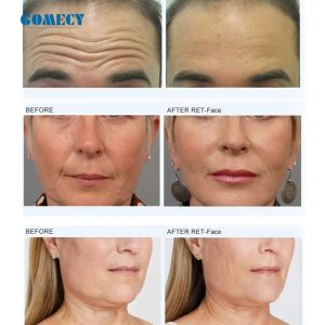 2024 EMS Increase Muscle Tension RF Firm Skin EMS RF Face electric muscle