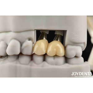Accurate Fit Implant-Supported Crown Bridge System With Resistance To Stains And