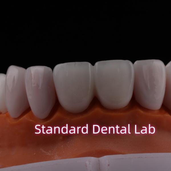 Tranlucent Emax Zirconia Laminate Veneers Porcelain Dental Veneers Chemically