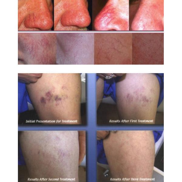 2016 newest 0.01mm and 0.03mm needle truly 30MHZ red vein vascular skin tag warts treatment devices best price