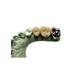 High Biocompatibility PFM Crown Porcelain Fused For Back Teeth Restoration