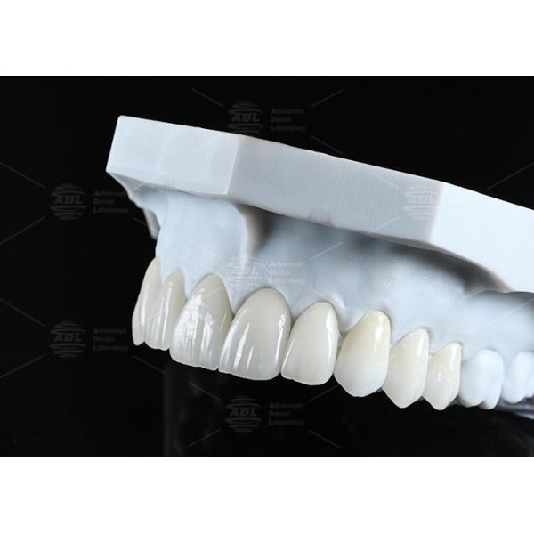 China Dental Lab High Esthetics Translucency EMAX Veneer with 0.3-0.5mm