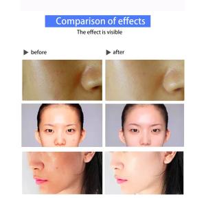 3 In 1 Acne Removal Eyelid Face Plexer Plasma Jett Skin Lifting Machine Cold And