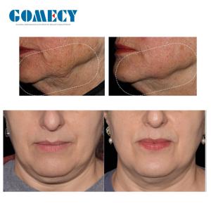 pulse electromagnetic for face beauty Sculpting EM Slim Machine for Anti Wrinkle