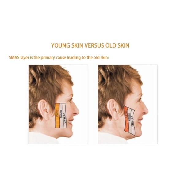 Face Lifting Wrinkle Removal 110v 220v RF Beauty Equipment