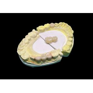 Advanced Translucency Ceramic Crowns and Bridges Enhance Your Smile with