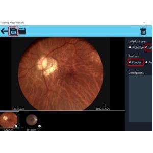 2560 X 1920 Pixels Digital Fundus Camera