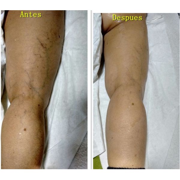 Instant Face Lift Hifu Machine Wrinkle Removal Machine High Intensity Focused