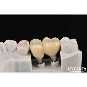 Accurate Fit Implant-Supported Crown Bridge System With Resistance To Stains And