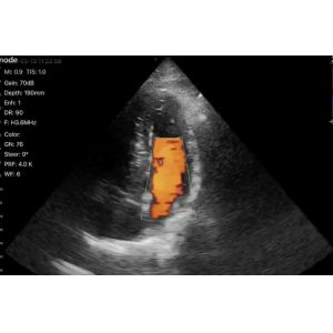 Wireless Phased Array Ultrasound Transducer Handheld Cardiac Echography Wireless