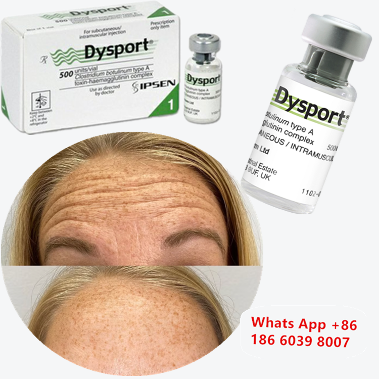 Dysport Botulinum Toxin Type A Injection for Wrinkle Reduction