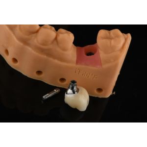 Wholesale Precision Cylindrical Silver Single Tooth Replacement Implants Dental Restoration from china suppliers