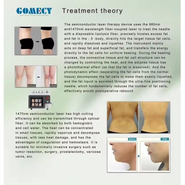 30W 1-10Hz Repetition Rate Endolift Laser Machine For Non Invasive Skin Tightening