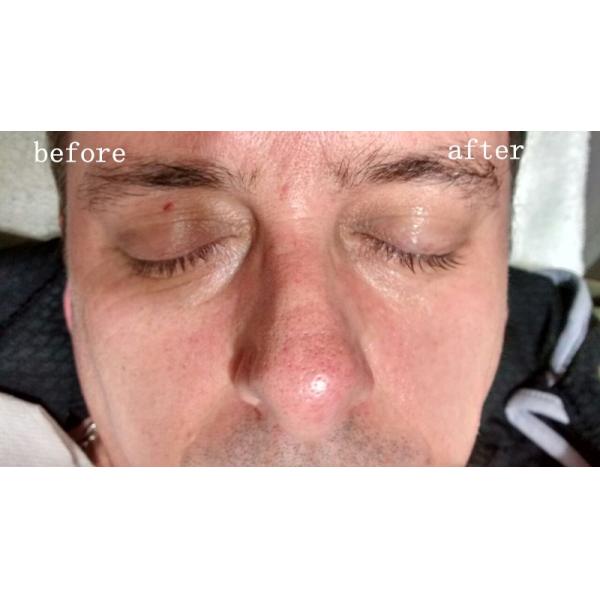 Instant Face Lift Hifu Machine Wrinkle Removal Machine High Intensity Focused