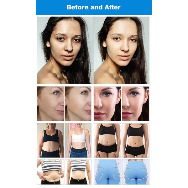 Ret Cet Rf Tecar Therapy Fat Burning Master Rf Body Slimming Machine