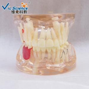 Full Mouth Teeth Pathology Model Teeth Models For Education With Half Implant