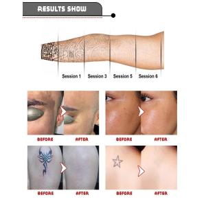 Microblading Q Switch Nd Yag Laser