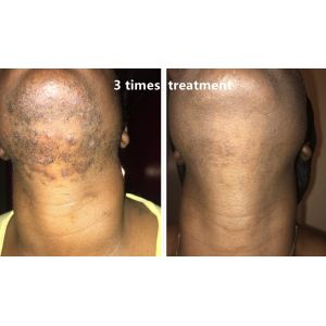 4 Wavelengths Diode Laser Hair Removal Machine 808nm/755 808nm 1064nm With User