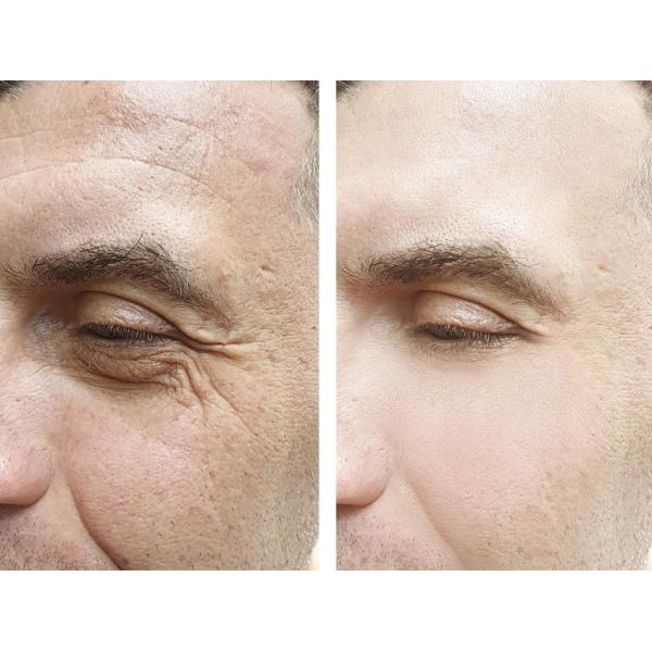 Anti Wrinkle 1ml Skinject Hyaluronic Acid Dermal Filler Sterile Injection