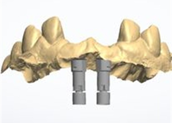 Natural-looking Zirconia Dental Crown with Excellent Biocompatibility and