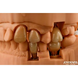 Wholesale Customizable Implant Crown and Bridge Achieve a Natural Look with Long-lasting Results from china suppliers