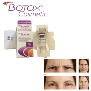 Allergan Injectable For Forehead Wrinkles 100ui