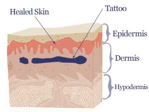 tattoo removal beauty equipment