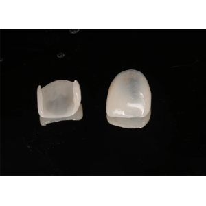 Aesthetic Restoration Emax Ceramic Veneers Translucency with Polished Surface