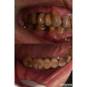 Rough Surface Design Dental Implant for Subcrestal Bone Level Titanium Material