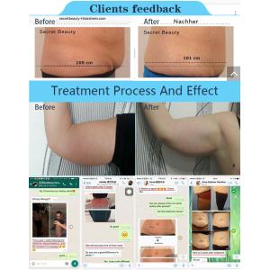 2018 Nubway Manufacturer Cryolipolysis+Vacuum+Multipolar RF+Cavitation Body