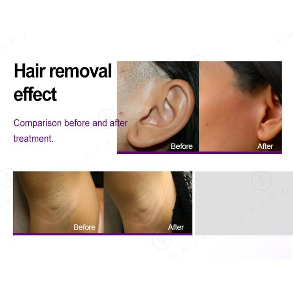 Stationary Diode Laser Hair Removal Machine 1200w Laser Epilation Equipment Three Wave