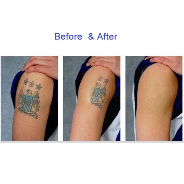 Facelift ND YAG Laser Machine