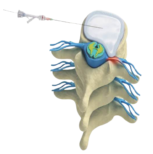 Micro Back Surgery 980nm Diode Laser For Lumbar Decompression Surgery