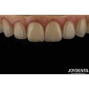 High Translucency Emax Cosmetic Dentistry Veneers High Aesthetics Ultra Thin