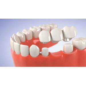 Porcelai CrownRealistic Color Stable Color Not Easy To Break Porcelain